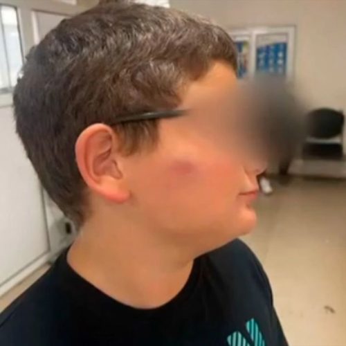 Θεσσαλονίκη: 11χρονος ξυλοκοπήθηκε στο σχολείο – «Μου είπαν να μάθει να αγνοεί το bullying», καταγγέλλει η μητέρα του