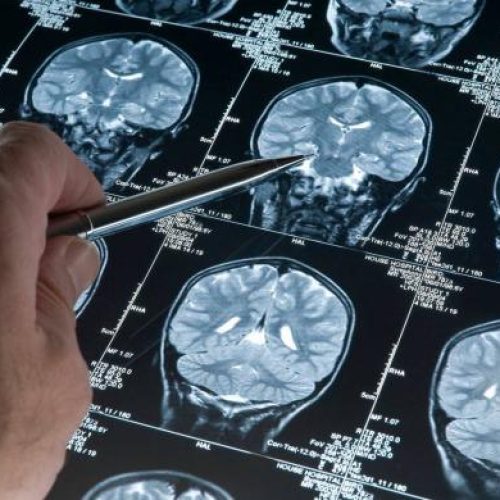 «Ποιο» είναι το γονίδιο που «ελέγχει» την ανάπτυξη του εγκεφάλου και του κρανίου