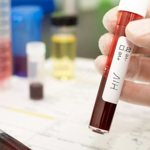 Συναγερμός για το AIDS: 21.800 κρούσματα HIV στην Ελλάδα – Ποιες δράσεις ξεκινούν