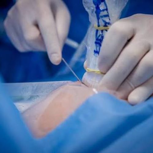 Ξέχασαν χειρουργικό εργαλείο μέσα σε ασθενή
