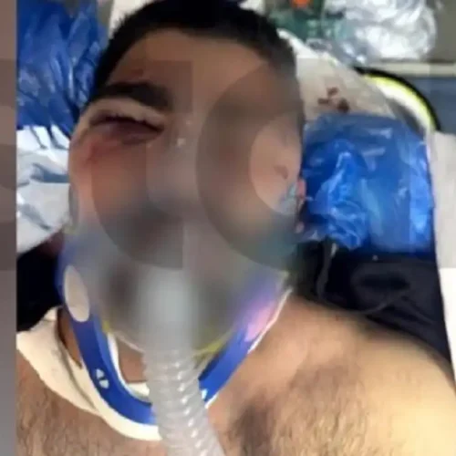 ΚΟΙΝΩΝΙΚΟ-ΣΟΚ: 20χρονος ξυλοκοπήθηκε άγρια με ασύρματο από αστυνομικούς – Η μητέρα δεν τον αναγνώρισε!