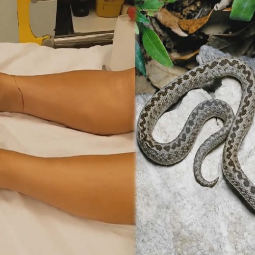 Νεότερη εξέλιξη στην υπόθεση της γυναίκας που δέχθηκε δάγκωμα από φίδι