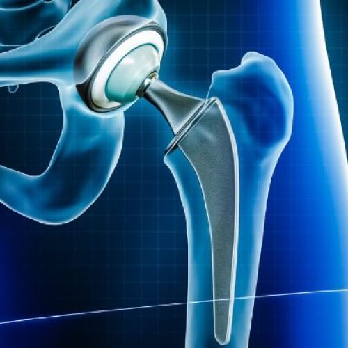 Συνταξιούχος νοσοκόμα λαμβάνει την πρώτη αντικατάσταση ισχίου με τη βοήθεια ρομπότ